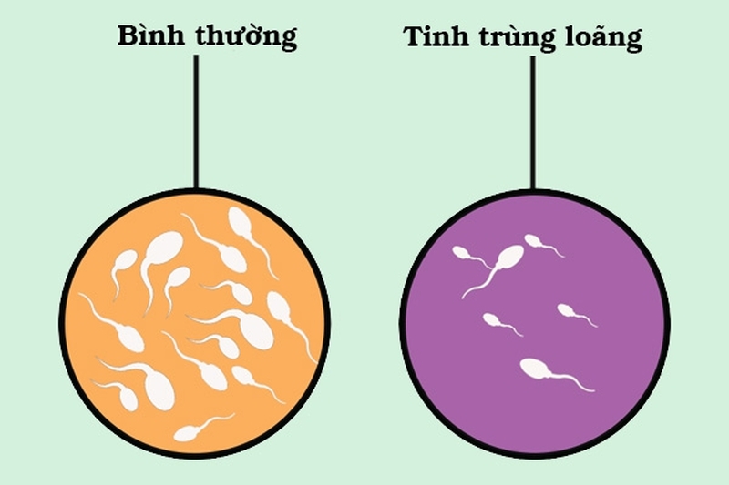 Tinh trùng loãng khiến nam giới khó thụ thai