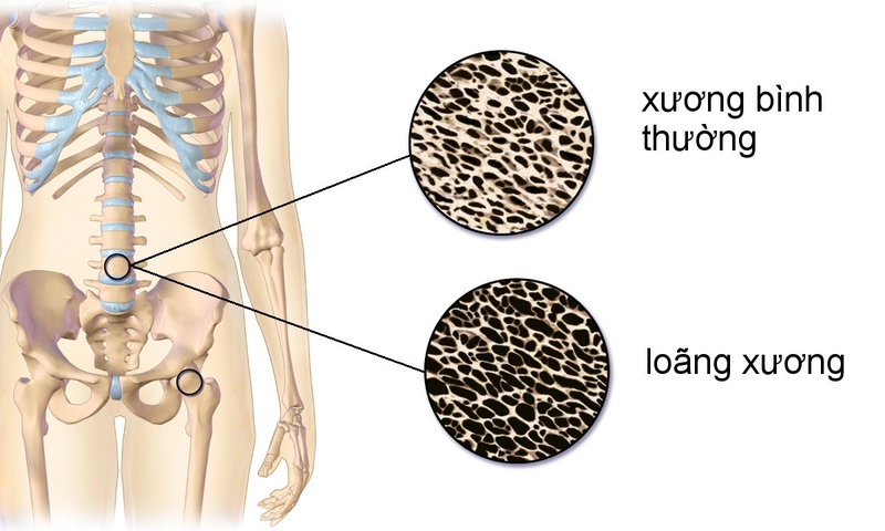 Tip bổ sung canxi để tránh loãng xương ở tuổi trung niên