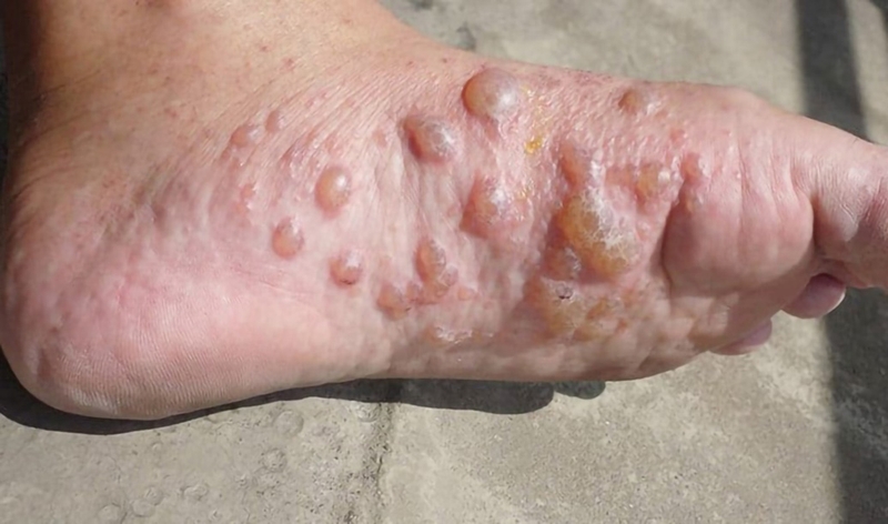 Tổ đỉa bội nhiễm: Nguyên nhân, biểu hiện và cách chữa trị 2