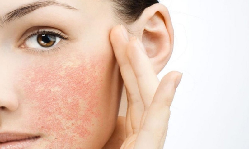 Tổ đỉa chàm dạng trứng sam: Nguyên nhân, triệu chứng, cách điều trị 2