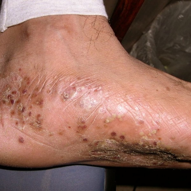 Tổ đỉa kẽ chân: Nguyên nhân, dấu hiệu và cách điều trị 2