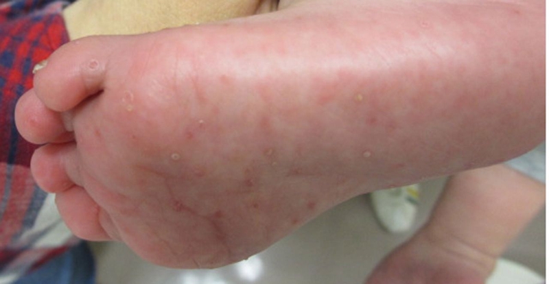 Tổ đỉa kẽ chân: Nguyên nhân, dấu hiệu và cách điều trị 4