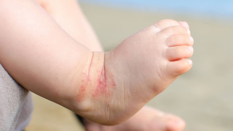 Phòng ngừa nấm da bàn chân như thế nào? 3