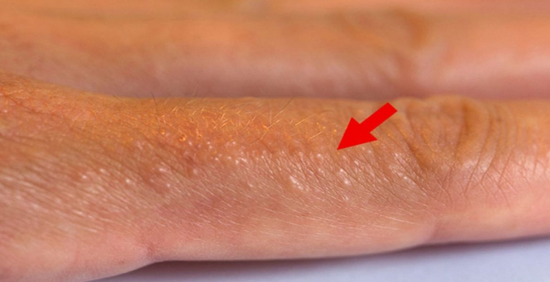 Tổ đỉa ở môi: Nguyên nhân, cách nhận biết và điều trị 1