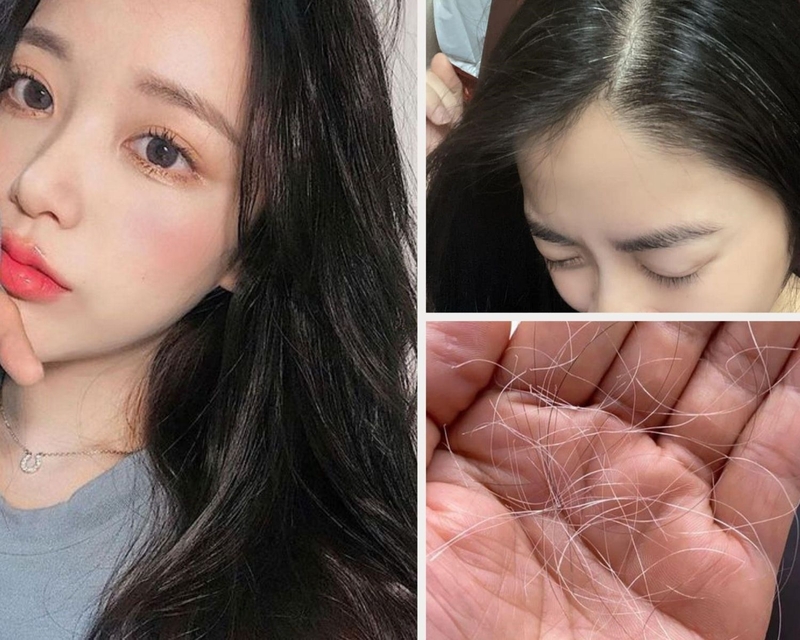 Người trẻ tuổi bị tóc bạc sớm có thể do mắc phải một số bệnh lý ảnh hưởng