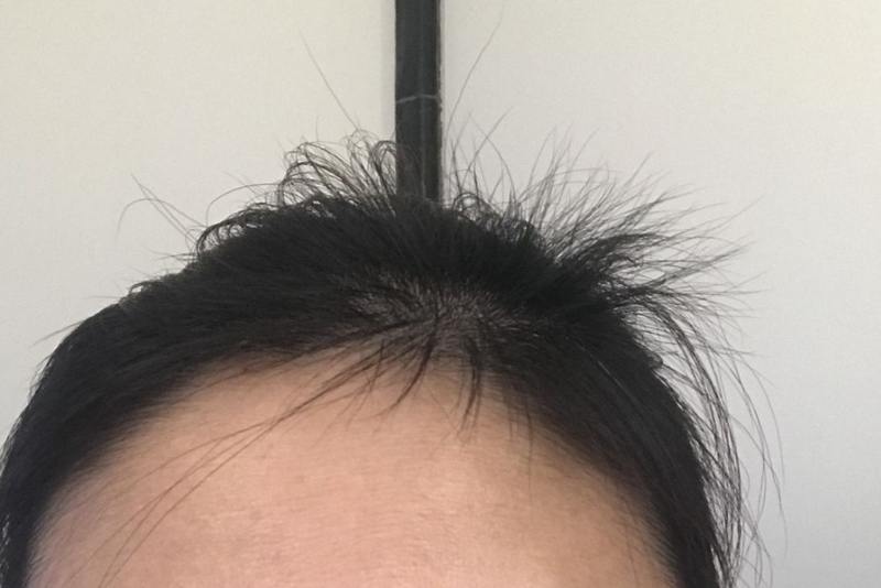 Tóc con mọc lởm chởm do nguyên nhân nào và phải làm sao 2