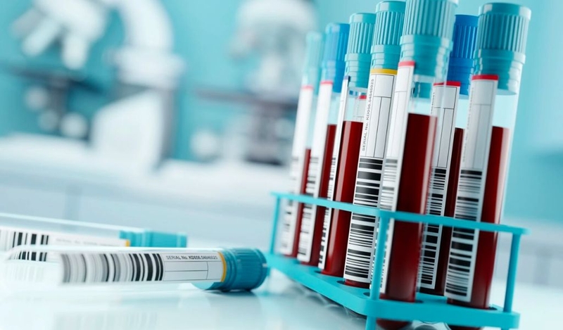 Tốc độ máu lắng trong viêm khớp dạng thấp? Các xét nghiệm chẩn đoán khác 2