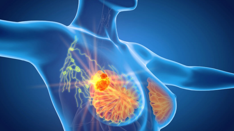 Tốc độ ung thư vú phát triển nhanh thế nào? Phương pháp sàng lọc và chẩn đoán sự phát triển ung thư vú 2