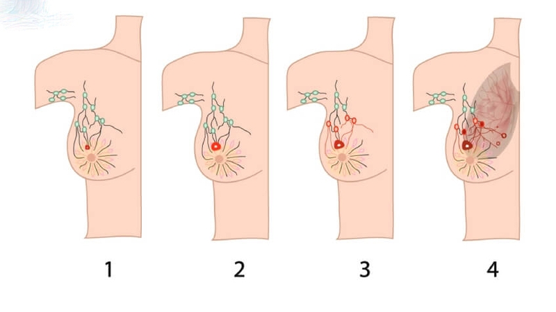 Tốc độ ung thư vú phát triển nhanh thế nào? Phương pháp sàng lọc và chẩn đoán sự phát triển ung thư vú 3