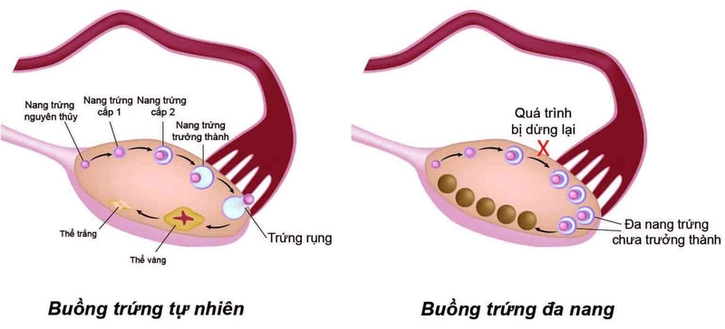 Tóc rụng nhiều là bệnh gì - Dấu hiệu cảnh báo bệnh buồng trứng đa nang