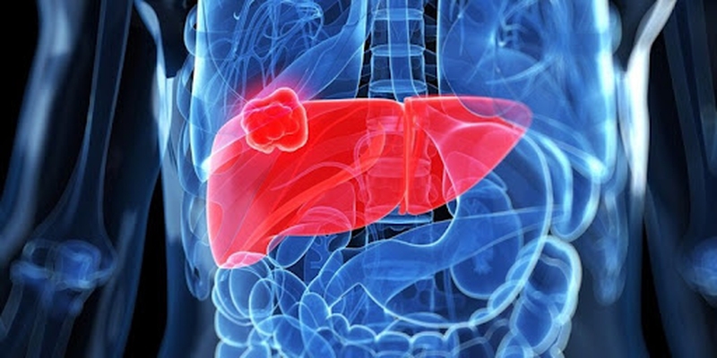 Tóm Tắt Về Các Khuyến Cáo Điều Trị Cho Ung Thư Gan Giai Đoạn Di Căn