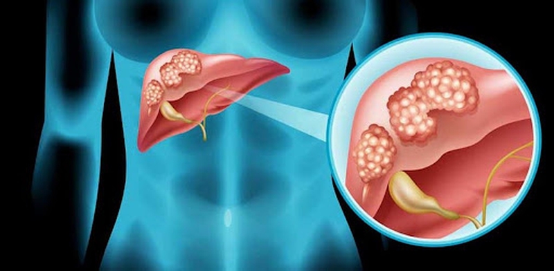 Tóm Tắt Về Các Khuyến Cáo Điều Trị Cho Ung Thư Gan Giai Đoạn Di Căn