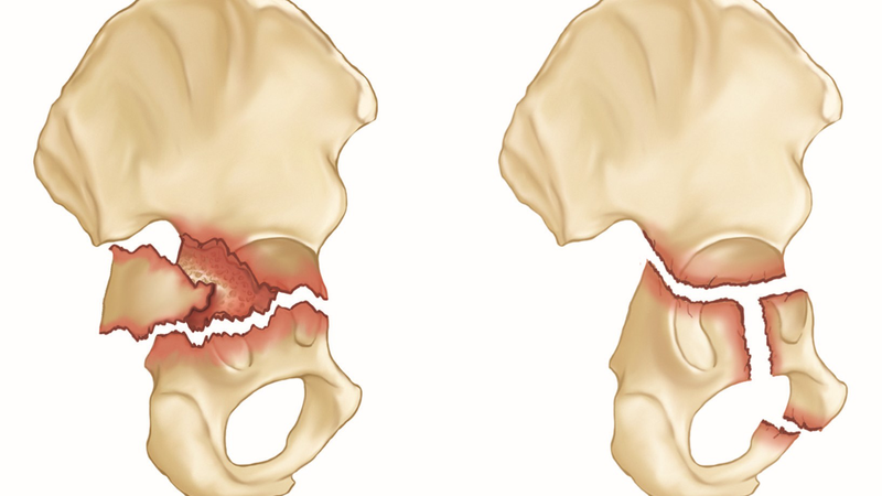 Tổn thương đám rối thần kinh thắt lưng