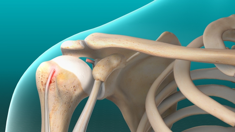 Tổn thương gân nhị đầu là gì? Nguyên nhân và cách điều trị 3