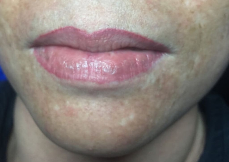 Tổng hợp 3 cách xử lý xăm môi bị đậm ở viền ngay tại nhà&nbsp;1