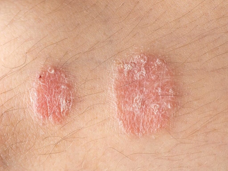 Tổng hợp 5 bệnh nấm da thường gặp và cách phòng ngừa 2