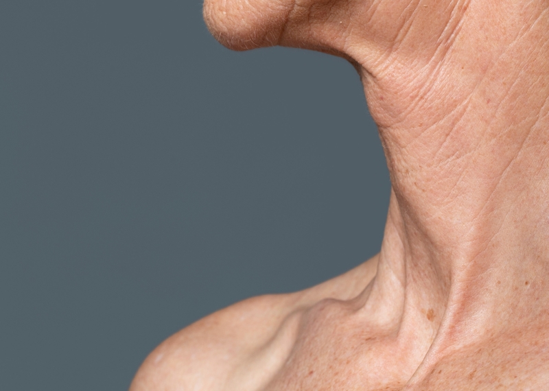 Tổng hợp 5 phương pháp tiêm trẻ hóa vùng cổ 1