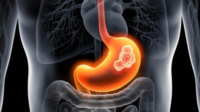 Tổng hợp các bệnh dạ dày thường gặp và dấu hiệu nhận biết 2