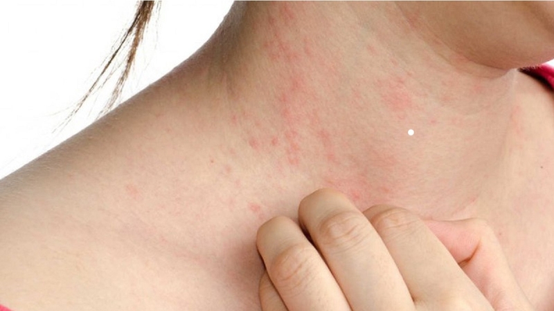 Tổng hợp các bệnh về hệ miễn dịch 3