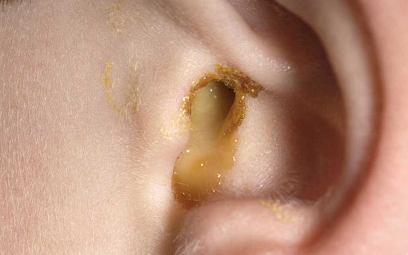 Tổng hợp các cách chữa viêm tai ngoài cho bà bầu an toàn, hiệu quả 1