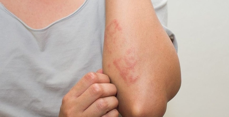 Tổng hợp các cách chữa zona thần kinh hiệu quả, hạn chế tái phát 3