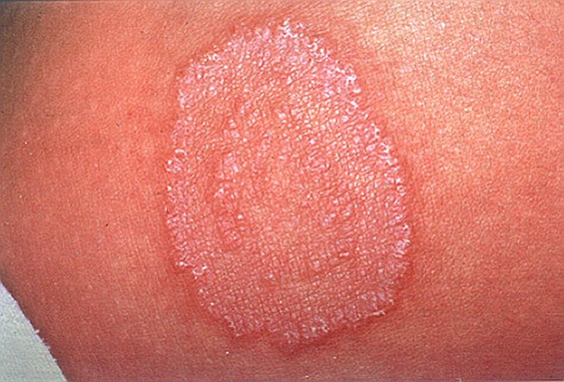 Tổng hợp các cách trị hắc lào bằng củ riềng phổ biến hiện nay 1