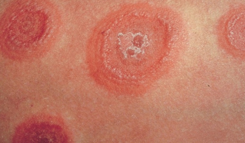 Tổng hợp các cách trị hắc lào bằng củ riềng phổ biến hiện nay 2