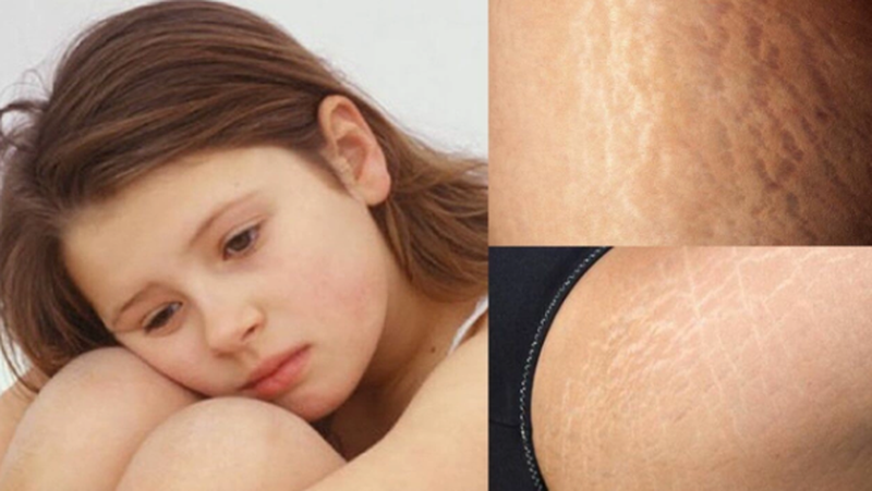 rạn da tuổi dậy thì