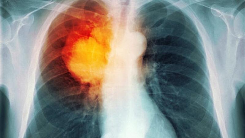 Tổng hợp các thông tin cần biết về X quang lao phổi 1