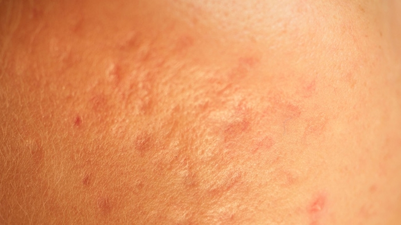 Tổng hợp hình ảnh thủy đậu qua các giai đoạn 10