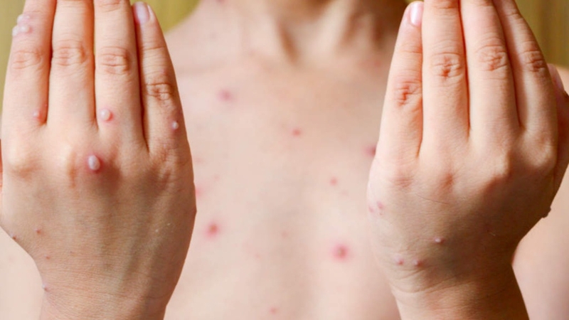 Tổng hợp hình ảnh thủy đậu qua các giai đoạn 8