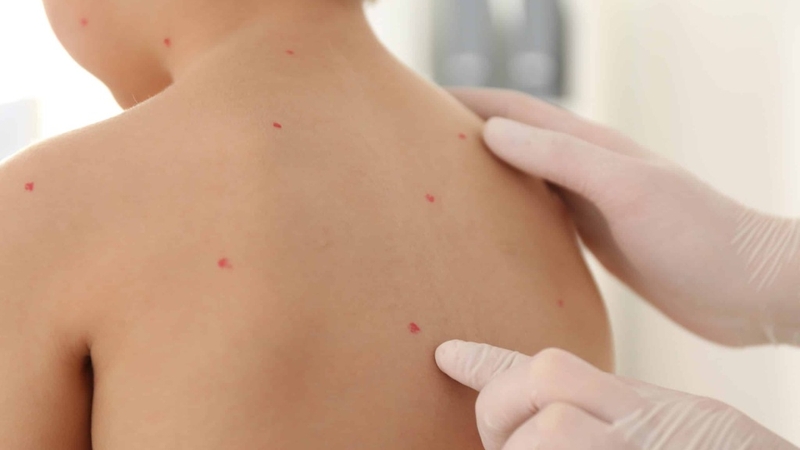 Tổng hợp hình ảnh thủy đậu qua các giai đoạn 7