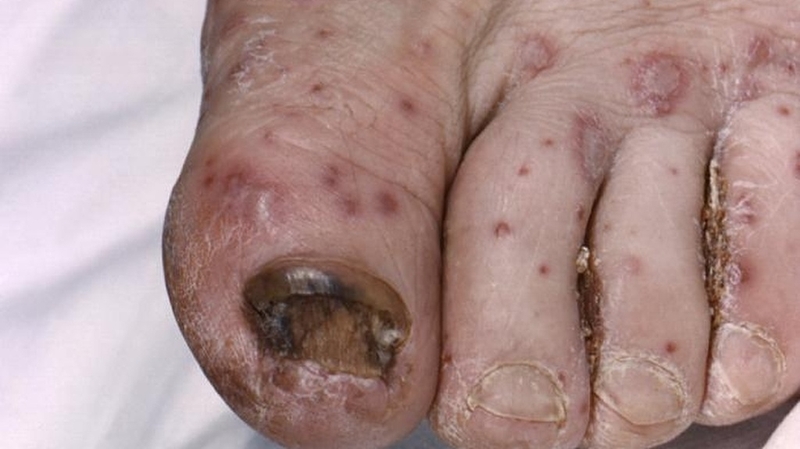 Tổng hợp hình ảnh thủy đậu qua các giai đoạn 6