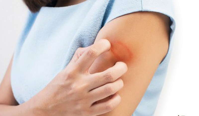 Triệu chứng bị hắc lào phổ biến là gây ngứa khó chịu
