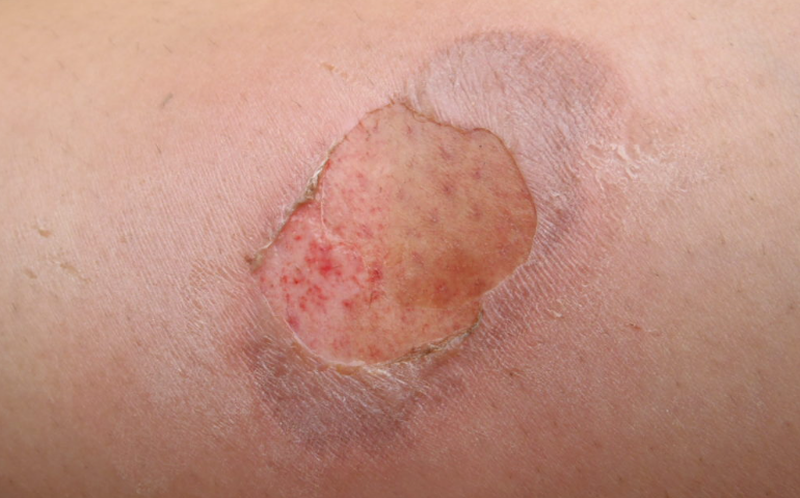 Tổng hợp những cách trị bỏng bô xe máy hiệu quả nhanh, không để lại sẹo 1