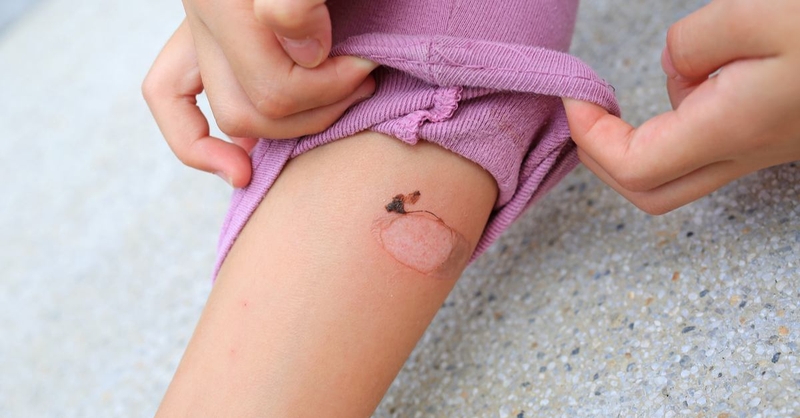 Tổng hợp những cách trị bỏng bô xe máy hiệu quả nhanh, không để lại sẹo 2