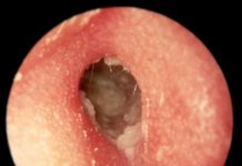 Tổng hợp những điều cần biết về nhọt ống tai ngoài 1