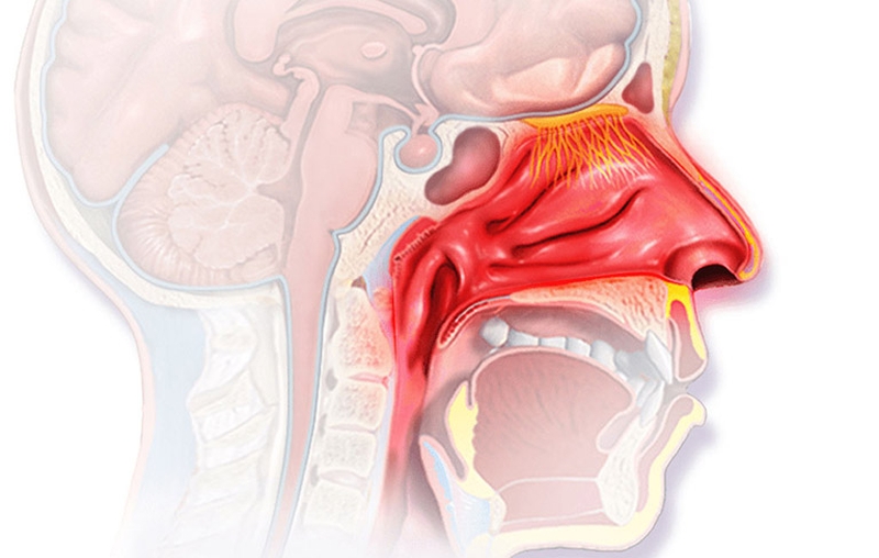 Tổng hợp những điều cần biết về viêm VA quá phát ở trẻ nhỏ 1