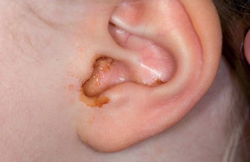 Tổng quan phác đồ điều trị viêm tai giữa mạn tính và cấp tính