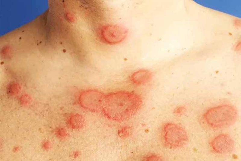 Tổng quan về bệnh lupus ban đỏ dạng đĩa 1