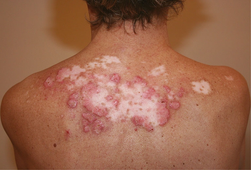 Tổng quan về bệnh lupus ban đỏ dạng đĩa 3