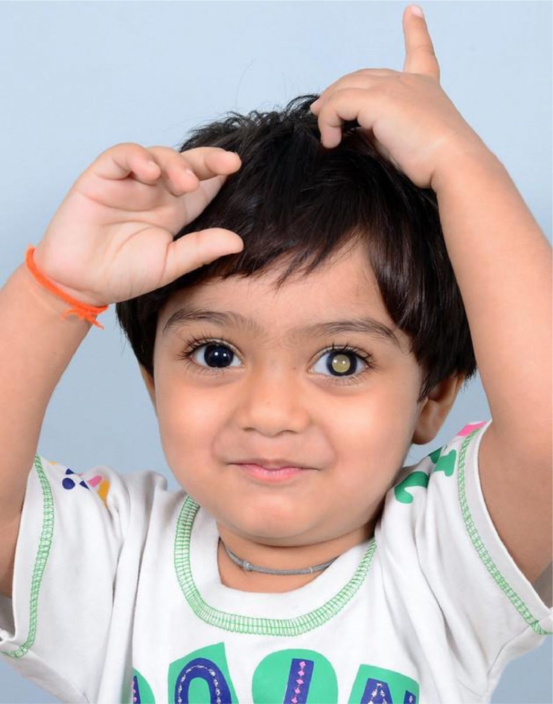 Tổng quan về các giai đoạn u nguyên bào võng mạc ở trẻ em2