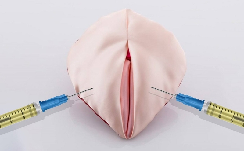 Tổng quan về phương pháp tiêm filler vùng kín dành cho chị em phái đẹp 1