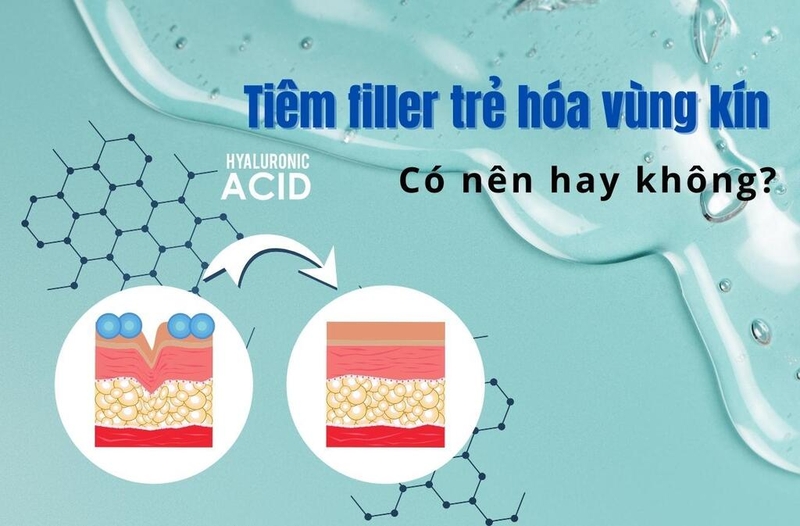 Tổng quan về phương pháp tiêm filler vùng kín dành cho chị em phái đẹp 2
