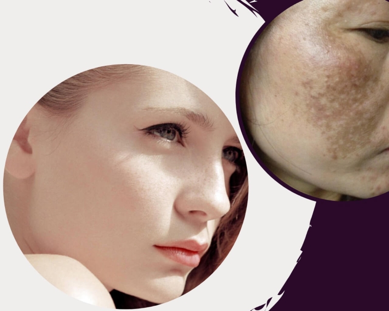 Top 10 cách loại bỏ tàn nhang hiệu quả bạn cần biết 2