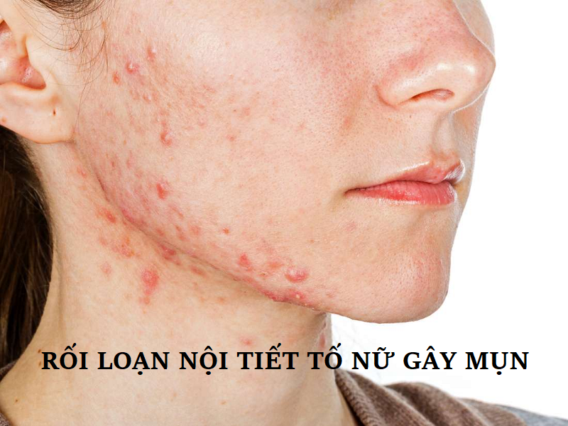 Thực phẩm chức năng trị mụn nội tiết có tác dụng kích thích cơ thể tự sản sinh hormone nội tiết tự nhiên.-2