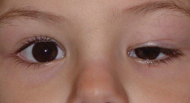 Top 3 cách trị mắt to mắt nhỏ đơn giản tại nhà 2