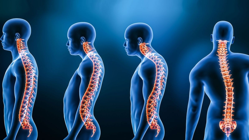 Top 4 bài tập cho người bị võng lưng - Thử ngay! 1