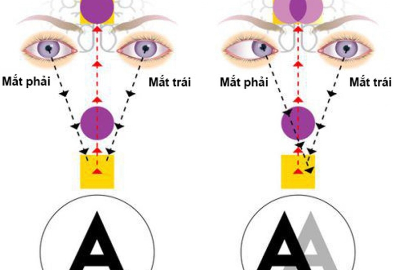 Top 4 bài tập mắt chữa song thị hiệu quả tại nhà 2