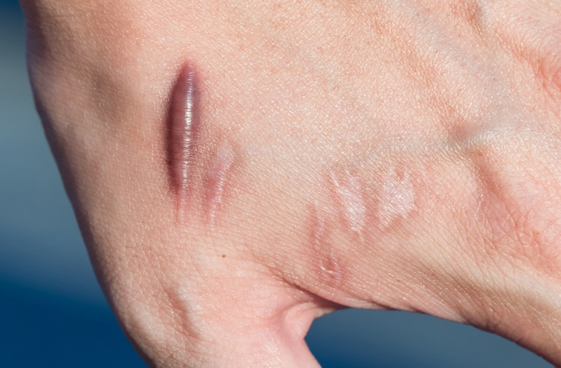 Top 4 kem trị sẹo phì đại đặc trị, an toàn khi sử dụng 1